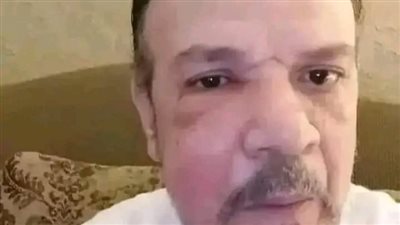 بعد ظهوره بوجه متورم.. أحمد سلامة يكشف عن طبيعة مرضه 