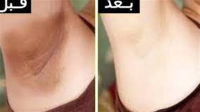  وصفات طبيعية لتفتيح الإبط الداكن