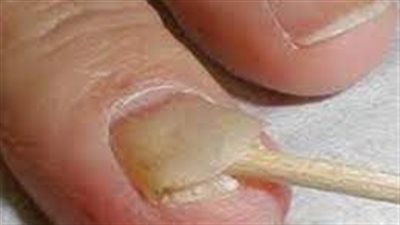 فطريات أظافر القدم: الأسباب والأعراض والعلاج