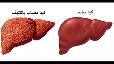 علامات في القدمين تدل على تليف الكبد